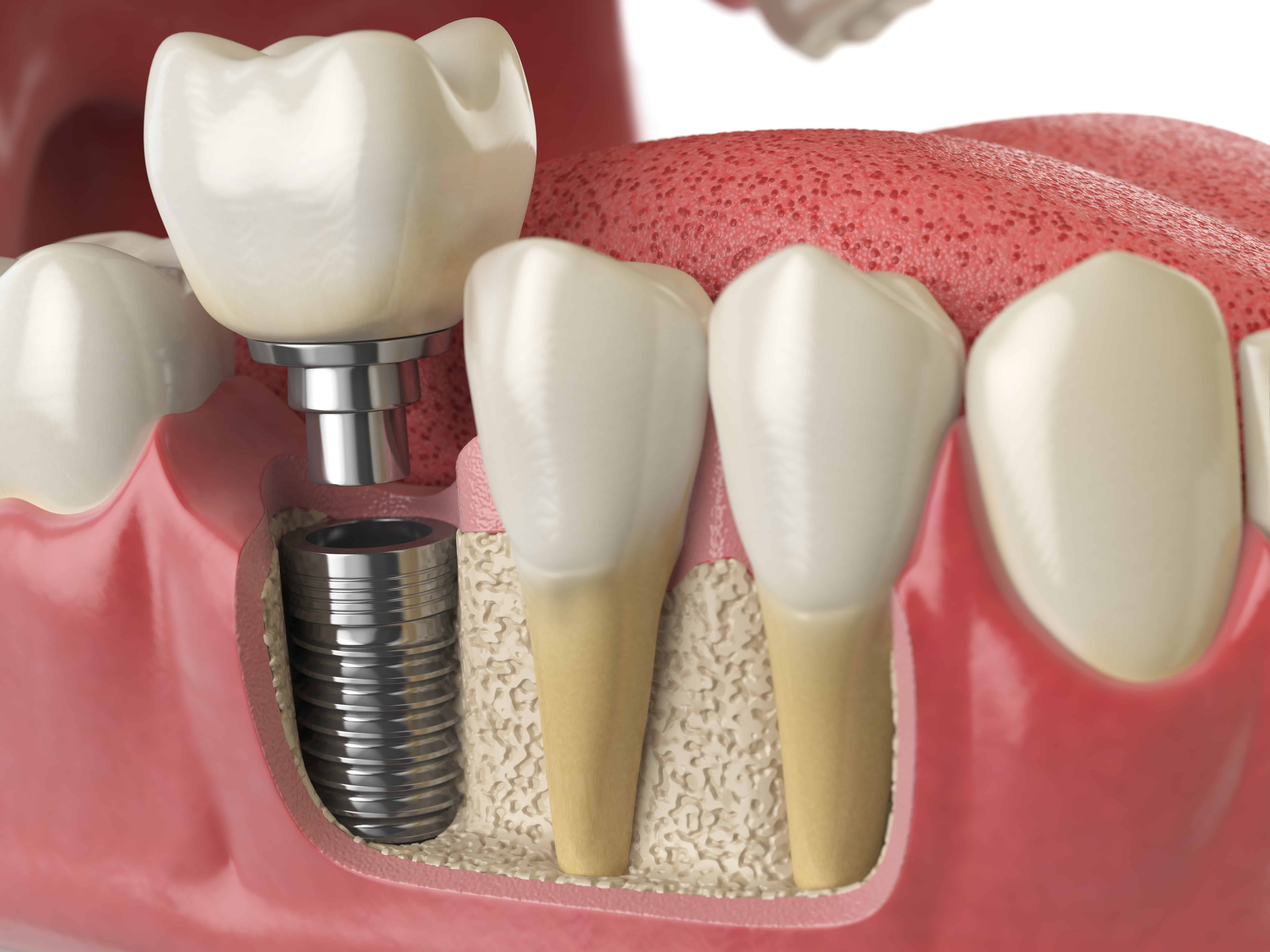 Where to find cosmetic dentists that Dental Implants